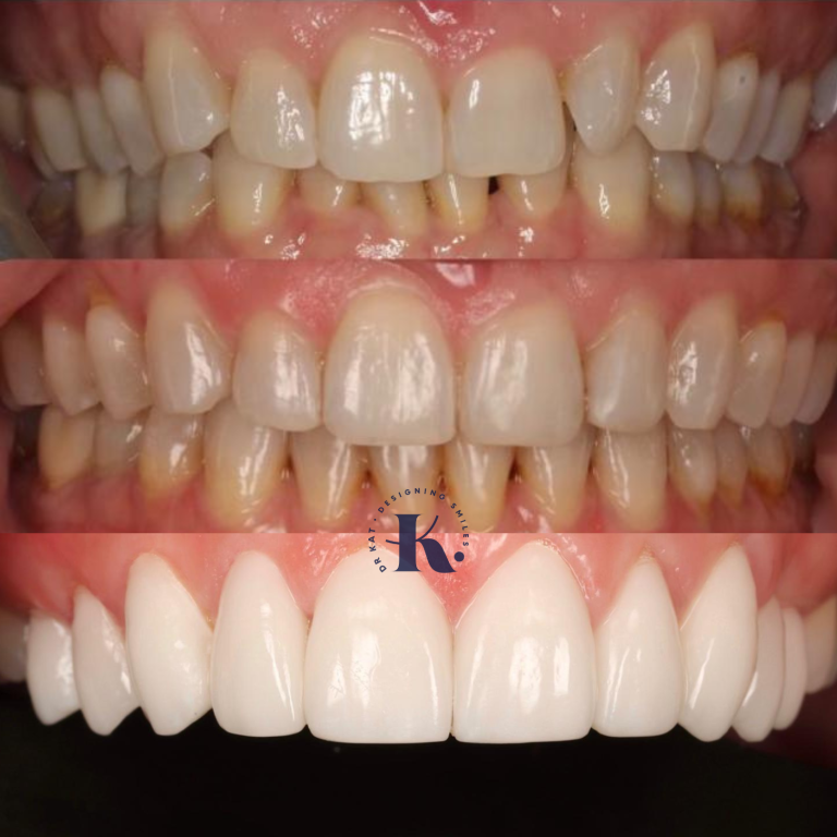 Porcelain Veneers, Close up, Before, After and final polish