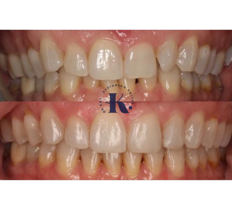 Porcelain Veneers, Close up, Before, After